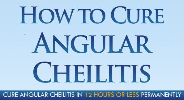angular cheilitis treatment